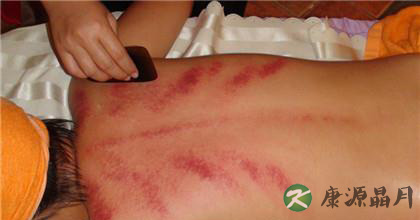 刮痧排毒的功效与注意事项