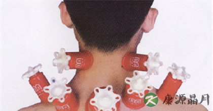 患了颈椎病还可以拔罐吗