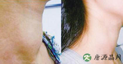 中医治疗甲亢效果怎样