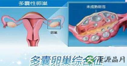 女性多囊卵巢怎么调理