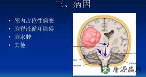 脑疝的症状