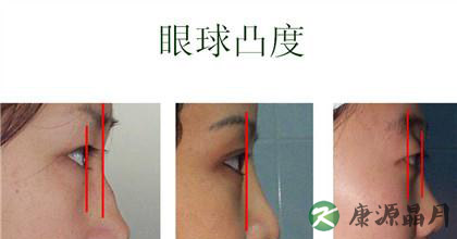 甲亢会遗传吗?专家来回答 甲亢会遗传吗?专家来回答