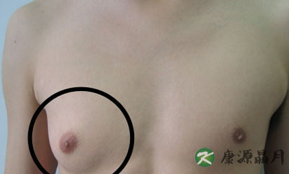 男人患乳腺癌，酒精是祸根