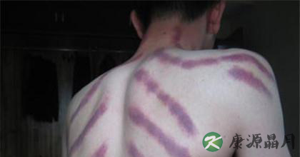 两则日记解读美女揪痧