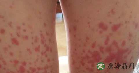 大腿肚内侧红点是什么