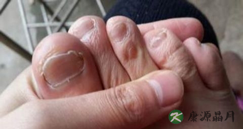 脚趾甲发白怎么办