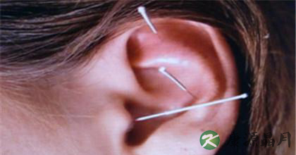 针灸治疗耳聋的作用机理 针灸治疗耳聋的作用机理