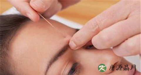 针灸治疗面瘫的方法 针灸治疗面瘫的方法