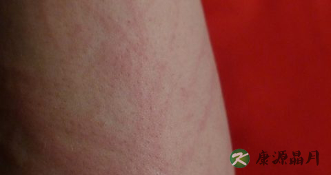 疥疮结节怎么治疗