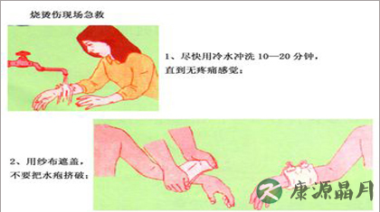 烫伤后怎样处理不留疤痕