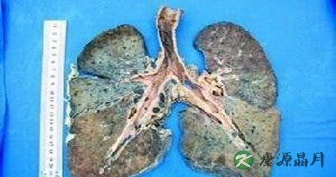 肺矽病的症状