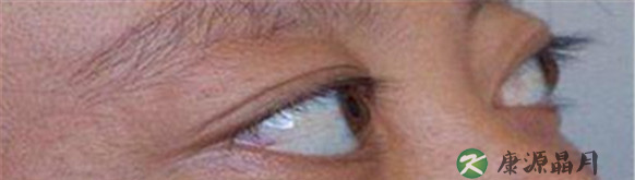 中医治疗甲亢效果怎样