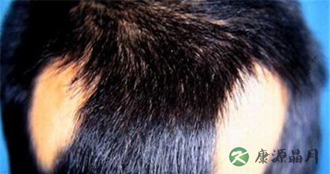 鬼剃头怎么治疗