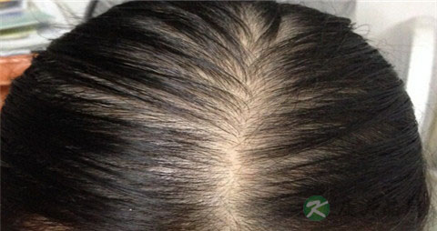 女性脱发偏方