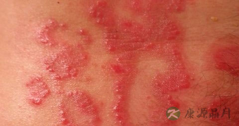 成人患上牛皮癣怎么治疗