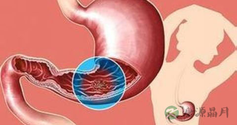 胃溃疡的食疗偏方