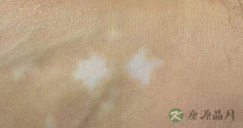 白斑病治疗的正规方法