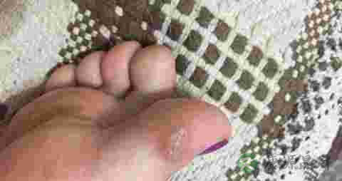 鸡眼怎么治疗