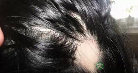 治疗斑秃的偏方