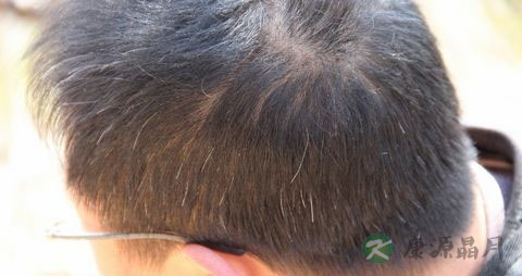 脂溢性脱发的治疗