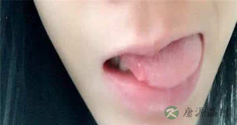 口腔溃疡煲什么中药吃