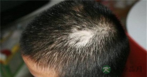 什么是脂溢性脱发用什么药