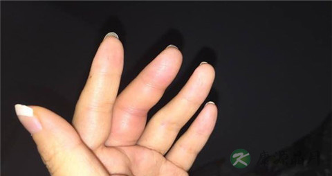 手指肿胀的原因