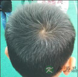 提醒！白发染黑发危害惊人