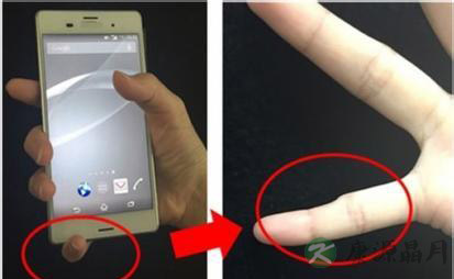 震惊!长期耍手机竟会让小指变形