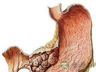 提醒!吃四类食物易患胃癌 提醒!吃四类食物易患胃癌