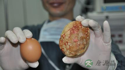 一日两瓶啤酒竟“喝”出肾结石 一日两瓶啤酒竟“喝”出肾结石