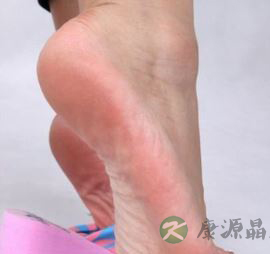 鸡眼、胼胝怎么办 如何预防足部皮肤角化过度
