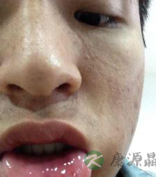 复发性口腔溃疡有三大症状 治疗可用两种方法