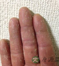 冬天手剥皮是怎么回事 可采取五大处理办法