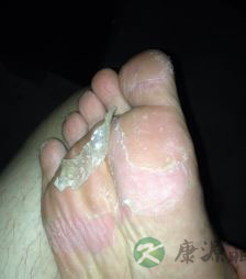 脚底脱皮痒有四大原因 六大妙招可有效制止