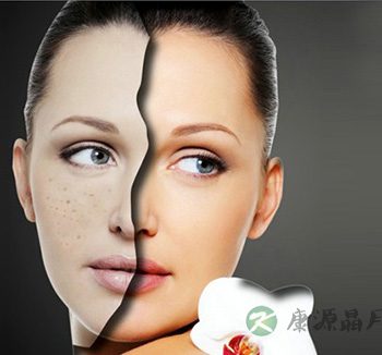 什么是激光祛斑 激光祛斑有副作用吗 什么是激光祛斑 激光祛斑有副作用吗