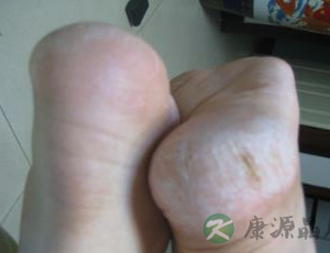 鸡眼、胼胝怎么办 如何预防足部皮肤角化过度