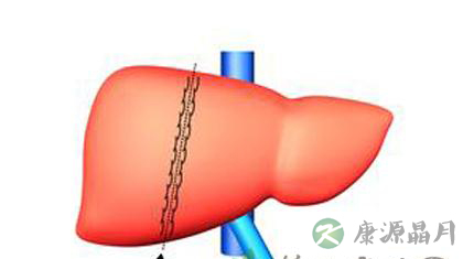 中医护肝五大秘诀