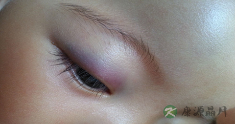 小儿眼睑浮肿是啥原因_小儿眼睑浮肿的原因