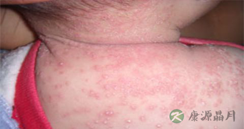 抗痱防痱有奇招_夏季如何抗痱防痱