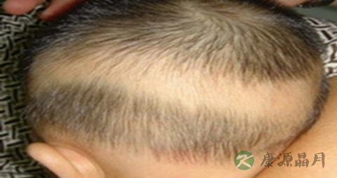 宝宝枕秃是什么原因_宝宝枕秃的原因