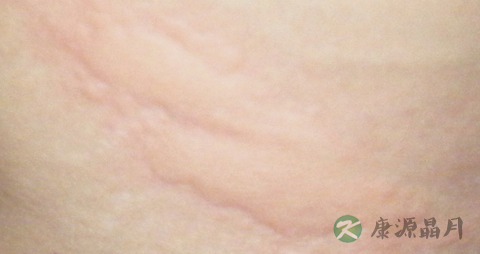 秋天荨麻疹的症状