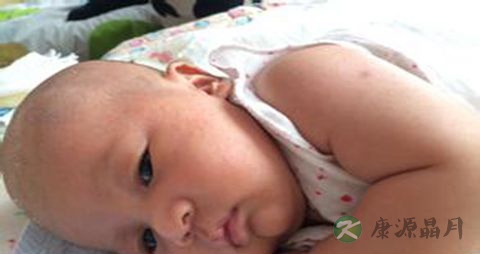 花露水治痱子好吗_夏日预防小儿得痱子