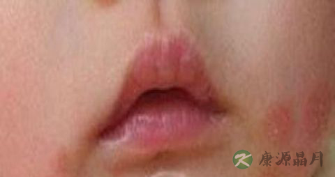 宝宝天热防湿疹的方法_宝宝天热怎样防湿疹