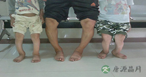 怎样预防佝偻病_预防佝偻病的方法