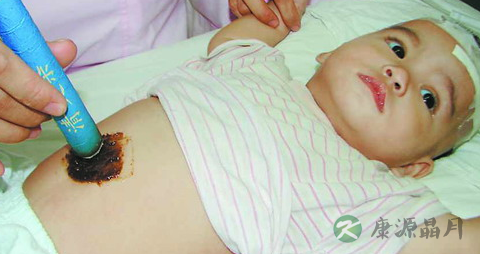 敷脐疗法治疗疾病_敷脐可以治疗小儿疾病