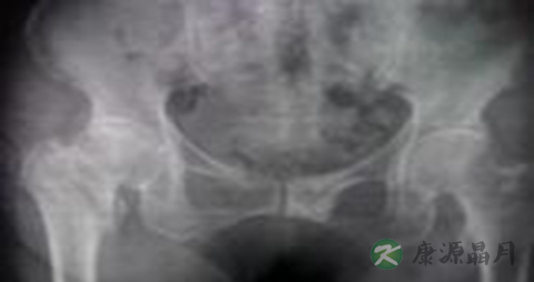 宝宝摔骨折了怎么办 宝宝摔骨折了怎么办