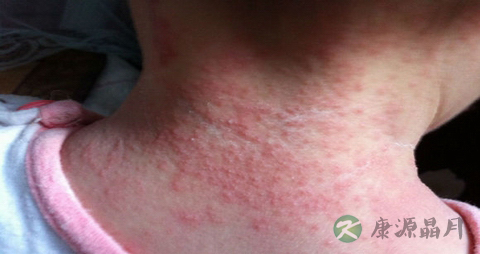 痱子是怎样引起的_宝宝要怎样预防痱子 痱子是怎样引起的_宝宝要怎样预防痱子