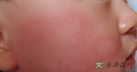 宝宝为何会过敏_过敏的原因