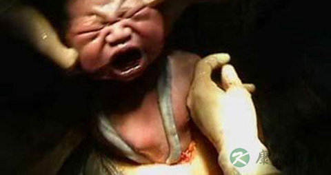 剖宫产对宝宝的影响_剖宫产宝宝存在的问题